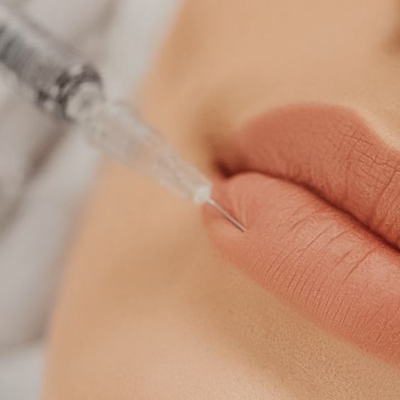 Preenchimento labial