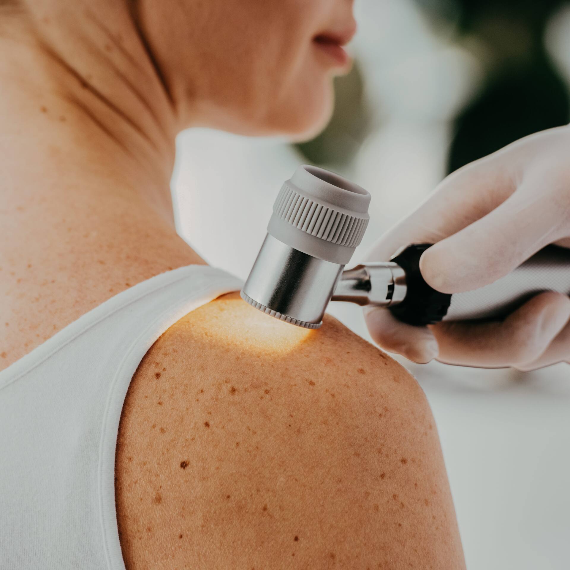 Melanoma