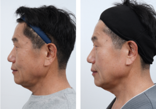 ultraformermpt antes x depois