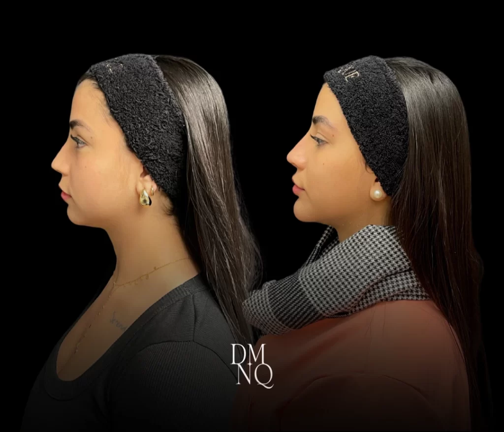 ultraformer antes e depois clinica dominique
