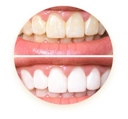 clareamento_dental_em_porto_alegre_dr_andre_tubino