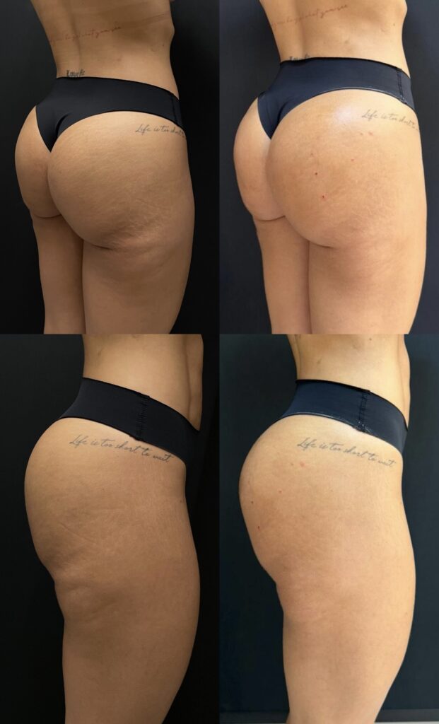 protocolo bumbum up clinica dominique em porto alegre