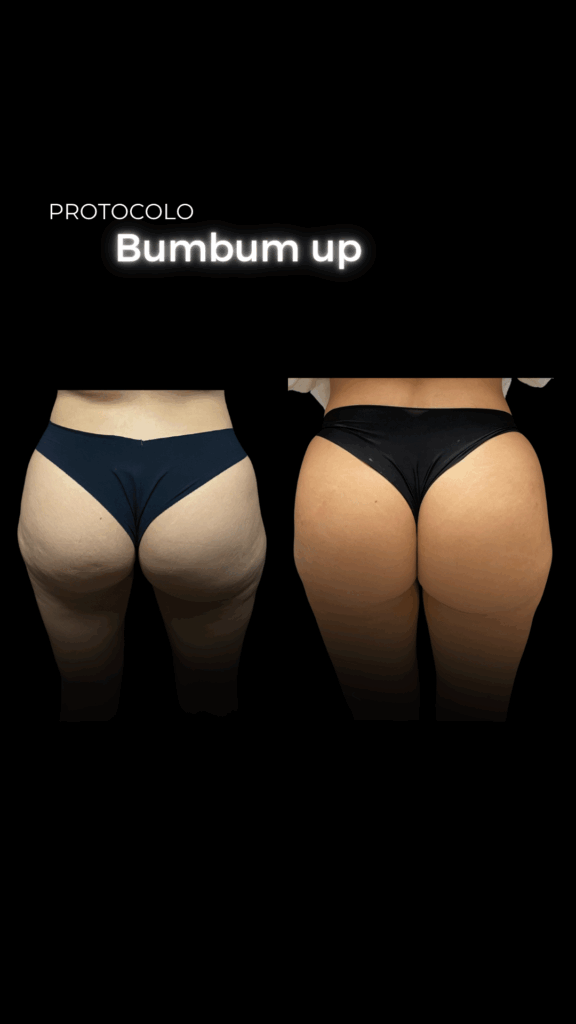 bumbum up antes x depois