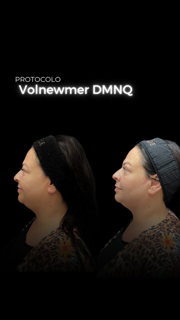 protocolo volnewmer antes e depois clinica dominique