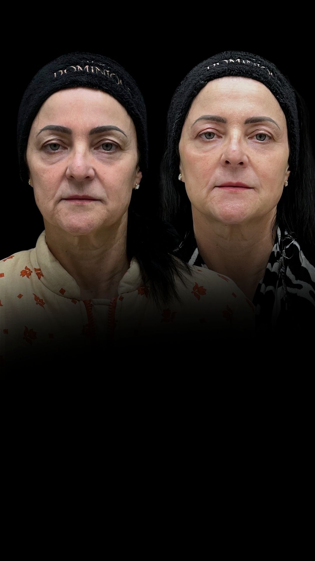 Comparação educativa de antes e depois de tratamento com laser CO2