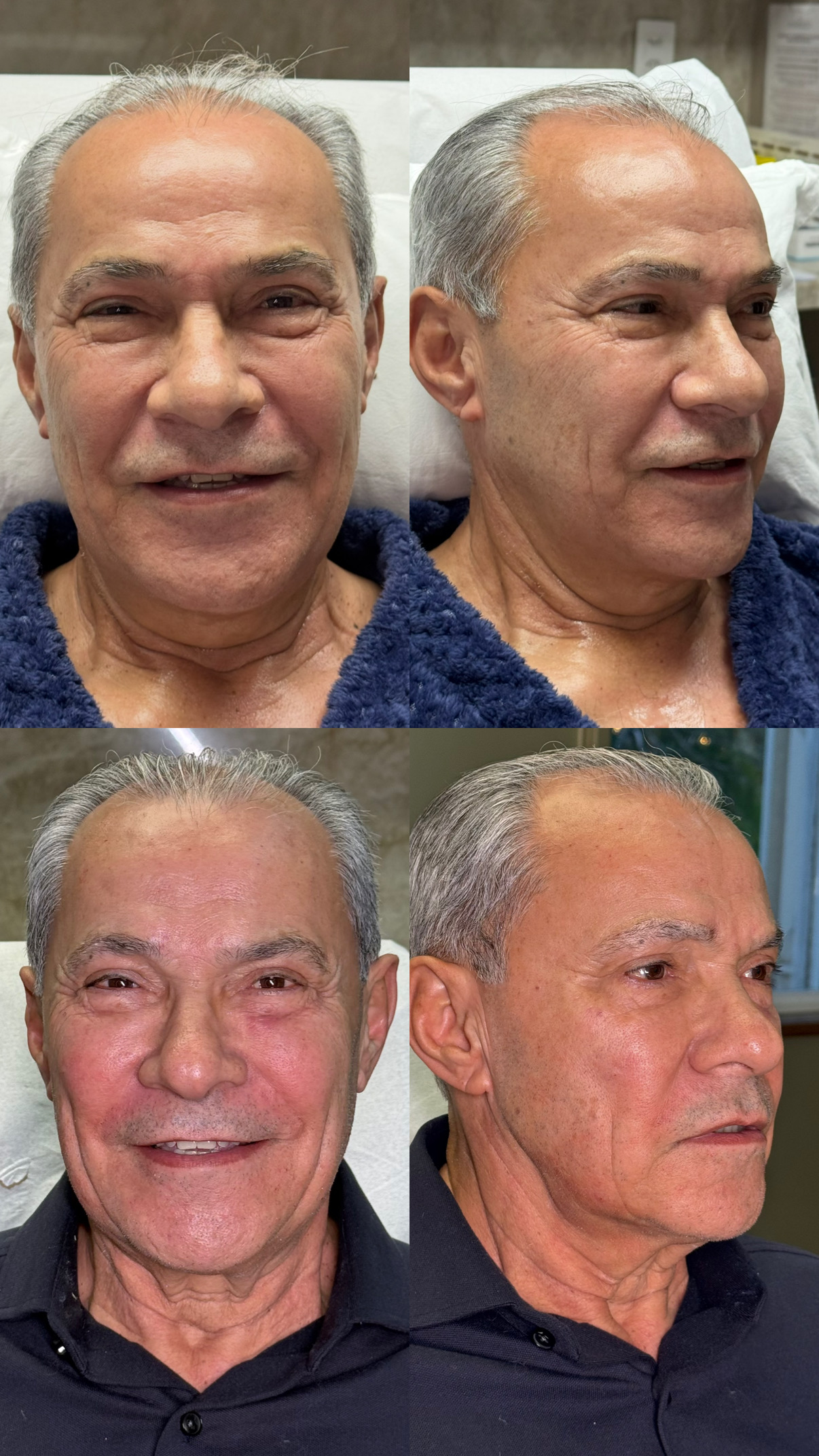 Segundo registro de antes e depois de tratamento com laser CO2